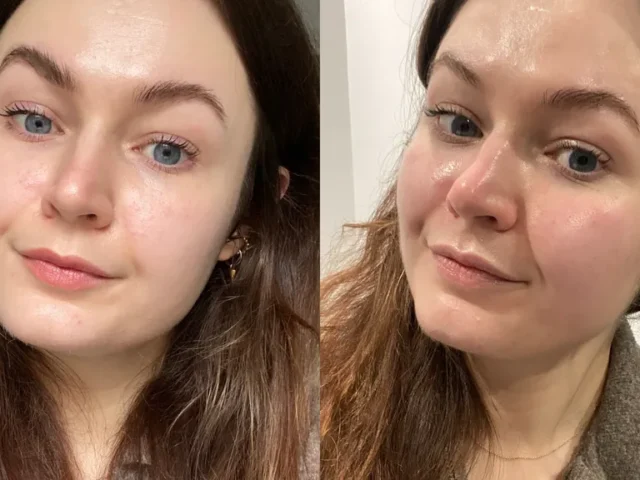 Hydrafacial гарантує сяйво та пружність - миттєвий заряд бадьорості для шкіри